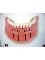 Implant Dentist Consultation - Dental Clinic Dr. Damir Dekorti
