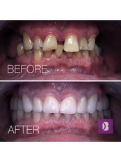 Dental Crowns - B Dent