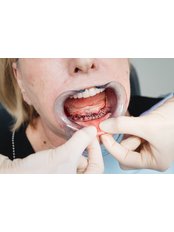 All-on-4 Dental Implants - B Dent