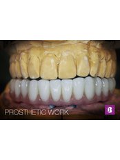 Immediate Dentures - B Dent