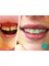 Dental clinic dr. Inga Vučković - Before and after veneers 