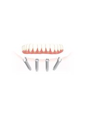 All-on-4 Dental Implants - Dental Implant Clinic Krhen
