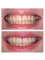 VISODENT Dental and Face Clinic - Visodent - veneers 