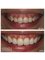Smalto Dental Clinic - Teeth Bleaching and Gingivoplasty 