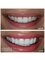 Smalto Dental Clinic - Odontoplasty -Teeth Bleaching - 4 Porcelain E-max Veneers 