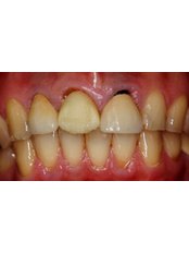 Dental Crowns - Smalto Dental Clinic