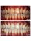 Smalto Dental Clinic - Teeth Whitening 