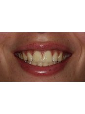 Teeth Whitening - Smalto Dental Clinic