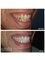 Smalto Dental Clinic - Minor orthodontic treatment -Teeth Whitening - 2 Porcelain Facings 
