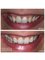 Smalto Dental Clinic - Composite Facing Restoration 2 Front Teeth - Gingivectomy 