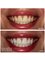 Smalto Dental Clinic - Teeth Bleaching 