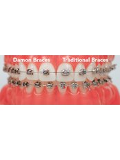 Damon™ Braces - Argyrou Orthodontics