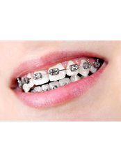 Metal Braces - Gnathion Dental Clinic