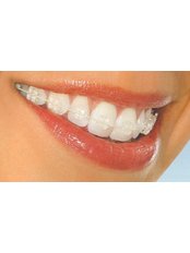 Clear Braces - Gnathion Dental Clinic