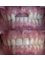 Gnathion Dental Clinic - Two Implants and two Veneers 