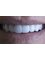 Gnathion Dental Clinic - All on 4 | Zirconium False teeth attached on 4 implants 