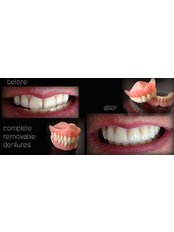 Dentures - Gnathion Dental Clinic