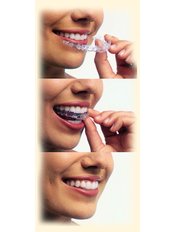 Invisalign™ - Gnathion Dental Clinic