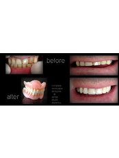 Dentures - Gnathion Dental Clinic