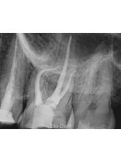 Molar Root Canal Treatment - BioDent tour s.r.o.