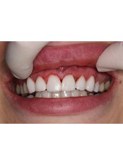 Dental Veneers - Right After - Prague Medical Institute - Dentistry