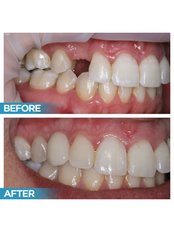 Dental Implant - Before and After - Prague Medical Institute - Dentistry