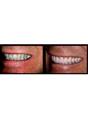 Dental Crowns - Before and After - Prague Medical Institute - Dentistry