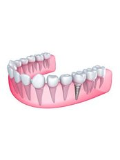 Dental implants - Prague Medical Institute - Dentistry