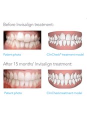 Invisilign Braces - Before and After - Prague Medical Institute - Dentistry