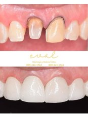 Dental Crowns - Eval Clinique