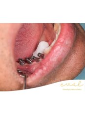Dental Implants - Eval Clinique