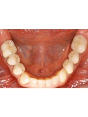 Dental Bridges - Asenjo One Visit Dentistry