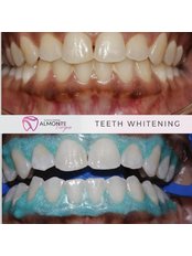 Teeth Whitening - Dental Clinic Almonte Vargas