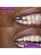 Dental Implants - Dental Clinic Almonte Vargas