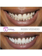 Veneers - Dental Clinic Almonte Vargas