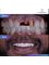 Dr. Jepssy Beltre DDS - Crown over teeth, crown over implant and veneers 
