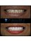 Dr. Jepssy Beltre DDS - 10 upper porcelain veneers with teeth whitening 