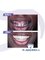 Dr. Jepssy Beltre DDS - Upper All-on-6 Zirconia Dentures 