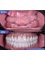 Dr. Jepssy Beltre DDS - All-on-6 Zirconia Dentures 