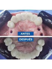 Dental Implants - TopDental by Dr. Victor Carreno