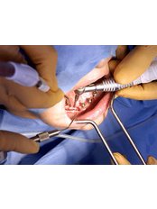 Dental Implants - Dental Quito Clinic