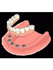 Implant Bridge - Dental Quito Clinic