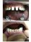 Dentental Implant Consultant - Cases before and after 