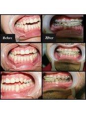 Braces - Prof. Hanan Ismail Orthodontic Clinic