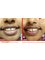 Tohamy Dental Clinic - Superior composite fillings 