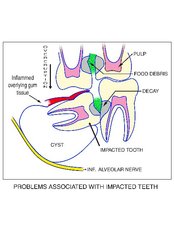 Wisdom Tooth Extraction - Abou-ElFetouh Clinic for Oral & Implant Surgery