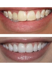 Porcelain Veneers - Bright Dental Clinic Dr Fadi Mourad