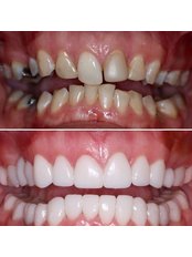 Full Mouth Rehabilitation - Bright Dental Clinic Dr Fadi Mourad