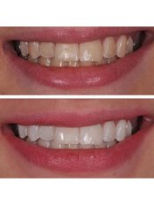 Teeth Whitening - Bright Dental Clinic Dr Fadi Mourad