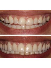Crown Lengthening - Bright Dental Clinic Dr Fadi Mourad